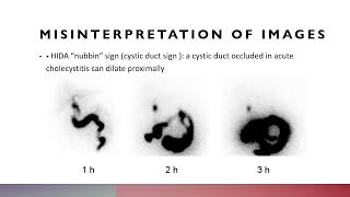 Hepatobiliary Scintigraphy MCQ HIDA Scintigraphy SCFHS nuclearmedicineMCQ nuclearmedicine [upl. by Gregoire]