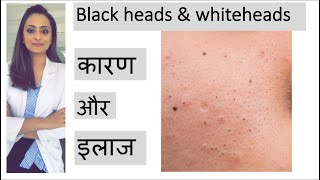 blackheads whiteheads treatment  ब्लाक हेड्ज़ को कैसे निकाले  त्वचा के डॉक्टर [upl. by Elakram]