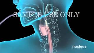 Upper Gastrointestinal Endoscopy EGD [upl. by Htez]