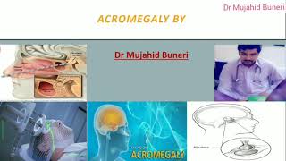 Achieve Mastery In Acromegaly Within 10 Minutes  Dr M B [upl. by Refotsirhc487]