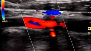 Internal Carotid Occlusion with Recanalizationwmv [upl. by Roze64]