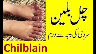 Chilblains on Toes  Treatment [upl. by Jacy]