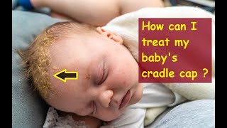 How can I treat my babys cradle cap [upl. by Corrie78]