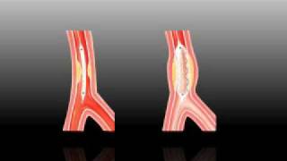 How is a Heart Attack Treated [upl. by Merwyn958]