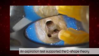 Treatment of a Cshaped canal by the SAF System  Dr Michael Solomonov [upl. by Josefina]