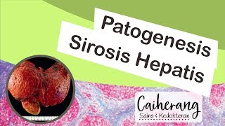 Definisi dan Patogenesis Sirosis Hati  Sirosis Hepatis [upl. by Tristram671]