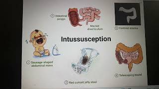 Intussusception part 1 [upl. by Amles]