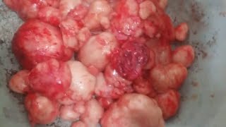 fibroids embolization is safe treatment as myomectomy [upl. by Rudolph179]