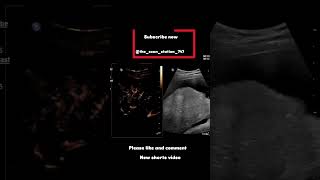 Hepatocellular carcinomadoctor ultrasound pregnant pediatrician baby abdomen pregnancyjourney [upl. by Nahtaneoj97]