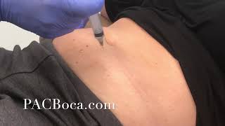 Lipolysis Injections Dr Sharabi PACBocacom [upl. by Euqinorev]