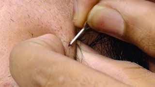 ASMR beard care ingrown hairs and removing pimple Hair ASMR Autonomous Sensory Meridian Response [upl. by Mindy]