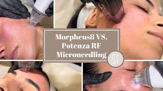 What is the Difference between Morpheus8 and Potenza RF Microneedling at SEV Laser [upl. by Ayota]