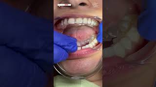 Invisalign Braces  Aligners for Teeth  Invisalign Time Lapse  invisalign invisalignsmile short [upl. by Oelc]