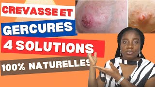 Comment Prevenir et Guerir les Grevasses et les Gercures [upl. by Tower]