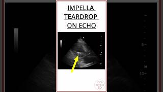 IMPELLA TEARDROP ON ECHOCARDIOGRAM A METALLIC CONE 7mm impellla [upl. by Lazaruk]