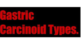 Gastric Carcinoid Types [upl. by Anauqahs]