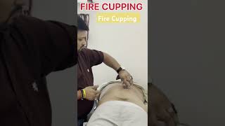 Fire Cupping for Back Pain drmanishgupta spinemanagement accuratehealthcare bestphysiotherapy [upl. by Neelrahc]