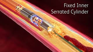 Rotarex™ Rotational Excisional Atherectomy System [upl. by Tuckie155]