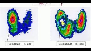 Radiology 11  THYROID SCAN [upl. by Bettzel212]