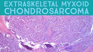 Extraskeletal myxoid chondrosarcoma rare soft tissue tumornot a real chondrosarcoma pathology [upl. by Annayehc]