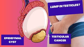 Testicular Lumps  Epididymal Cyst and Testicular Cancer [upl. by Le]