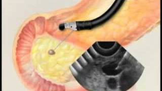 Endoscopic Ultrasound with Fine Needle Aspiration Biopsymp4 [upl. by Eniamrahc]