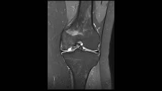 Osteochondritis dissecans [upl. by Mccomb786]