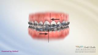 Elastics  Anterior Cross  Orthodontic Treatment  Orthodontic Treatment [upl. by Lilias678]