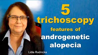 The 5 trichoscopy features of androgenetic alopecia [upl. by Annot259]