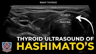 Thyroid Ultrasound of Hashimotos [upl. by Clotilde]