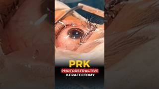 Live Photorefractive Keratectomy PRK Surgery [upl. by Assenab502]