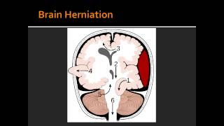 Intracranial Hemorrhage  Epidural Hematoma [upl. by Eilasor806]