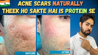 Remove Acne Scars Naturally  3 Remedies 100 Works With Results [upl. by Latin]