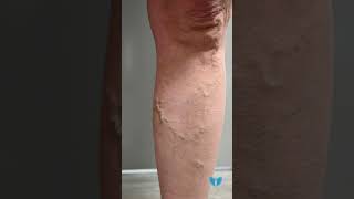 What to Expect During and After a VenaSeal™ Procedure for Varicose Vein Treatment [upl. by Jew217]