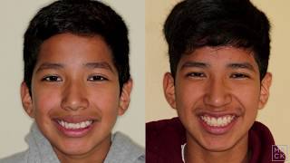 Traditional Braces to Fix Severe Overbite Overjet and Crowding with Extractions [upl. by Nazarius]