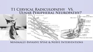 How to Differentiate T1 Cervical Radiculopathy vs Ulnar Nerve Neuropathy Cubital Tunnel Syndrome [upl. by Ardnosac449]