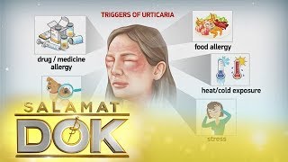 Salamat Dok Causes and symptoms of urticaria [upl. by Akived]