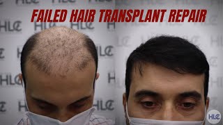 Failed Hair Transplant Repair Hair transplant before and after [upl. by Hanej776]