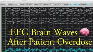 EEG Brain Waves After an Overdose [upl. by Aroled]