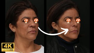 ANTES E DEPOIS DE RINOPLASTIA EM NARIZ NEGROIDE [upl. by Assirehs]