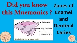 Mnemonics  Histological Zones of Enamel and Dentinal Caries [upl. by Bortz]