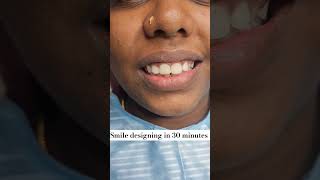 Broken Front teeth correction in madurai [upl. by Hsotnas262]