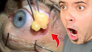 Popping huge blackheads and Giant Pimples Best Pimple Popping Videos [upl. by Cybill149]