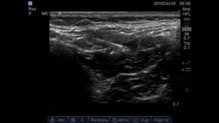 Quadratus lumborum 2 block [upl. by Tubb]