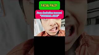 Facial palsy or Bells palsy signs and symptoms [upl. by Ttelracs]