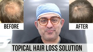 Topical Finasteride and Minoxidil HAIR LOSS Solution [upl. by Kluge]