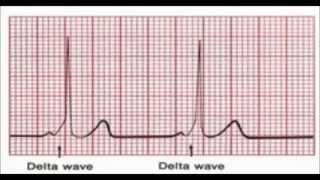 In your EKG How to Identify Delta wave in WPW What Is [upl. by Thenna]