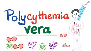 Polycythemia Vera PV  Myeloproliferative Neoplasm MPN  Erythrocytosis  Hematology [upl. by Barbara-Anne]