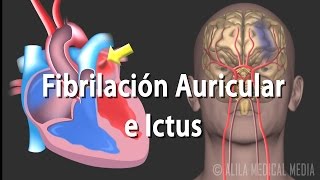 Fibrilación Auricular e Ictus Animación Alila Medical Media Español [upl. by Zoubek]