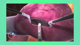 Atrial Septal Defect Repair at SSM Heart Institute [upl. by Esyla]